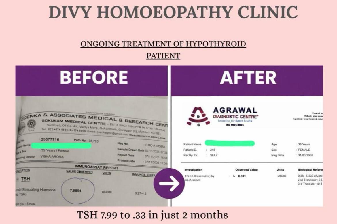 Hypothyroid before and after result